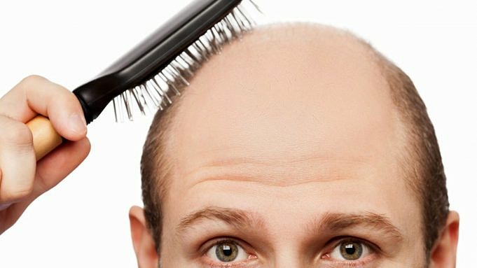 3 Wege, Um Zu Wissen, Dass Es Zeit Für Einen Haarausfall-Arzt Sein Könnte